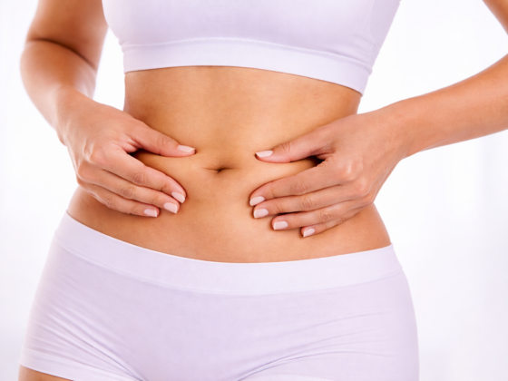 Stretch Mark Removal